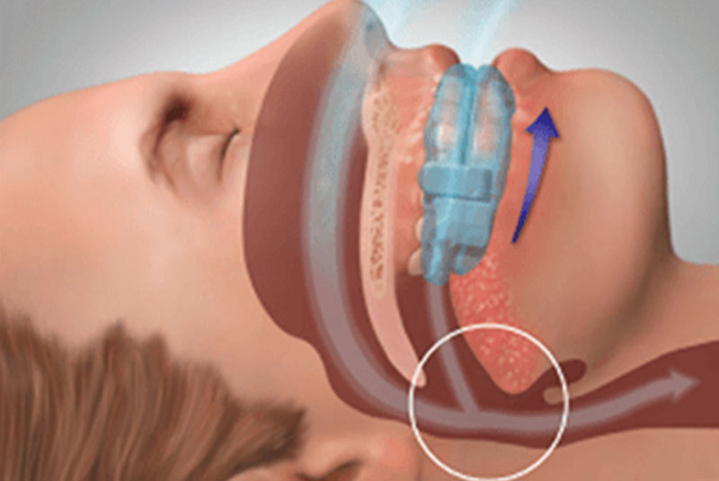 Oral Sleep Appliance