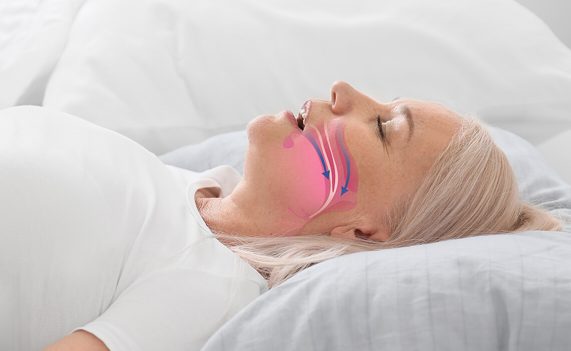 The Silent Epidemic: A Deep Dive into Obstructive Sleep Apnea